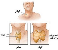 گواتر ساده (منتشر) یا غم باد