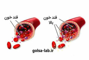 آزمایش قند خون در محمدشهر