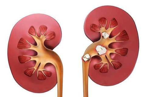 علائم سنگ کلیه
