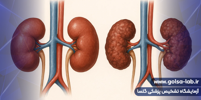 پیشگیری از نارسایی کلیه